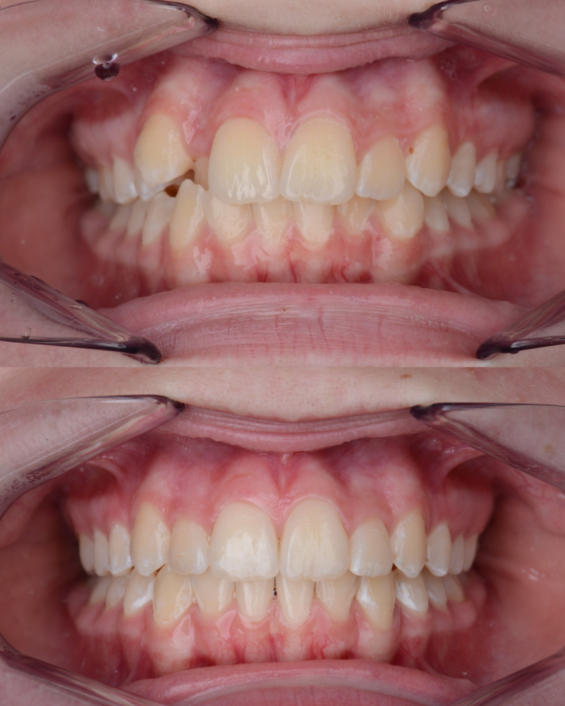Metamorfoza 15-letniej pacjentki po 18 miesiącach leczenia nakładkami Invisalign na Goździkowski