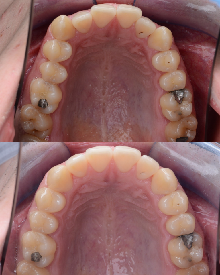 Metamorfoza pacjenta 24 lata po 12 miesiącach leczenia nakładkami Invisalign poprawiająca ustawienie zębów i okluzję